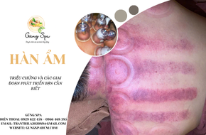 Hàn Ẩm - Triệu Chứng Và Các Giai Đoạn Phát Triển Bạn Cần Biết